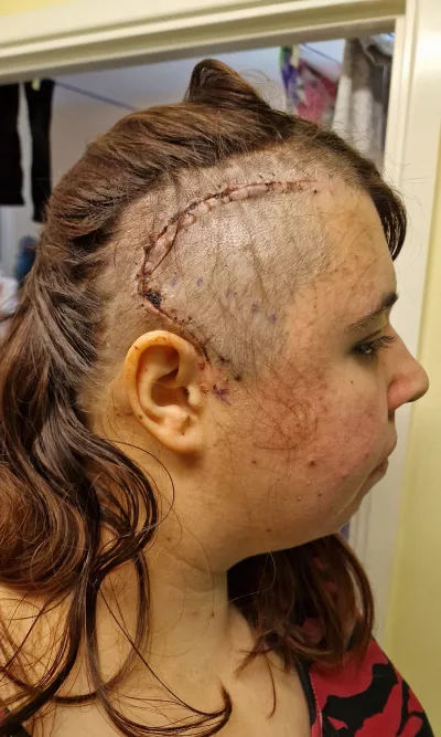 Laura shows a large, stitched-up scar across her head from brain surgery.