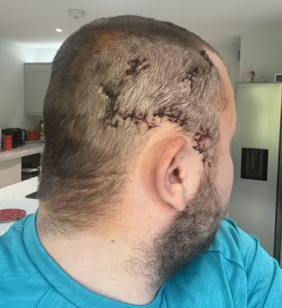 A young man shows off his surgery scar.